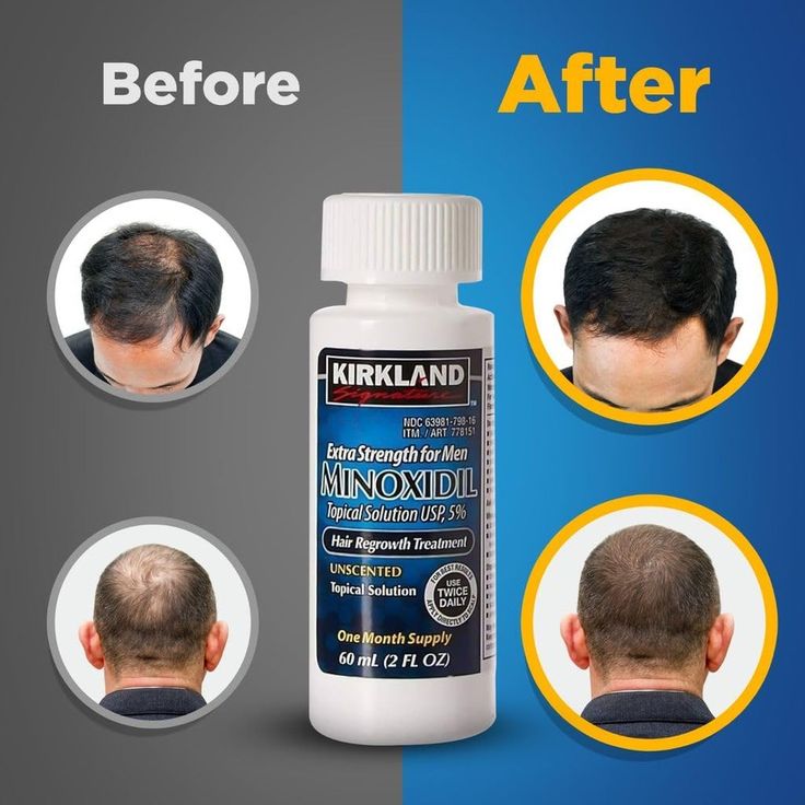 minoxidil hair growth